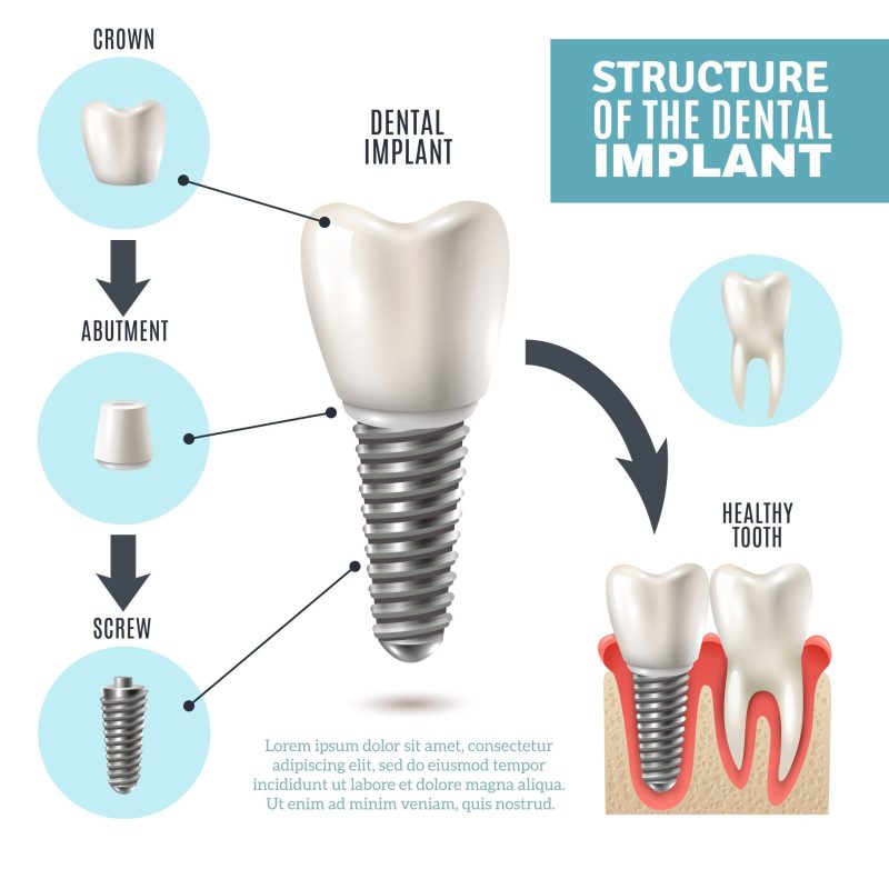 Cấu trúc trụ Implant