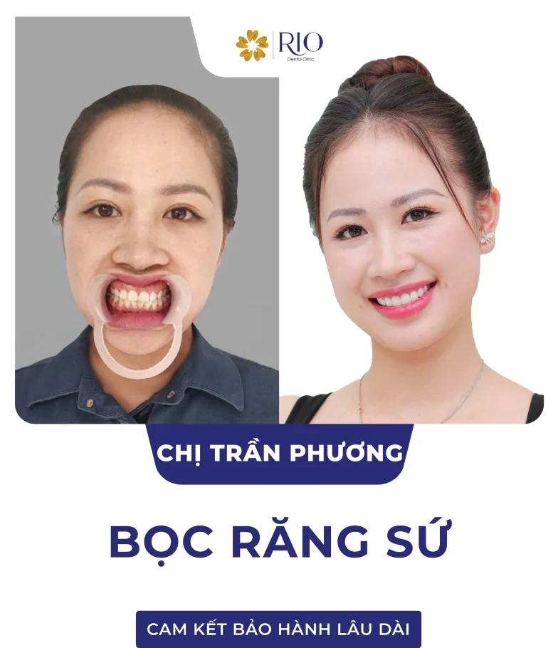 Chị Trần Phương - Bọc răng sứ