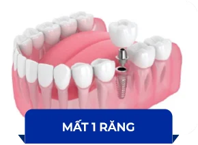 Hình ảnh Mất 1 răng