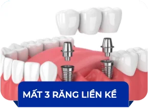 Hình ảnh Mất 3 răng liền kề