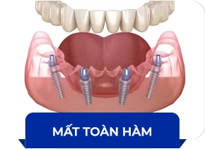 Hình ảnh Mất toàn hàm