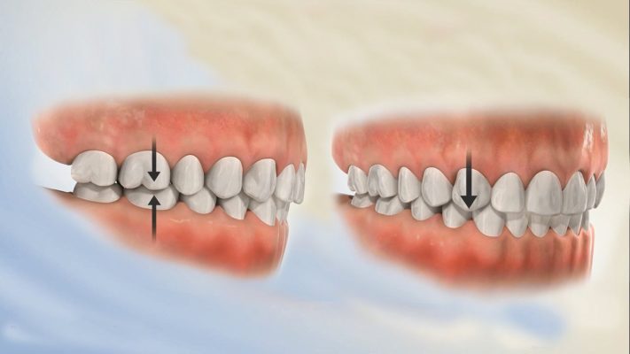 Răng bị lệch dẫn đến trường hợp lệch khớp cắn, cùng với đó khả năng ăn nhai cũng sẽ bị suy giảm.
