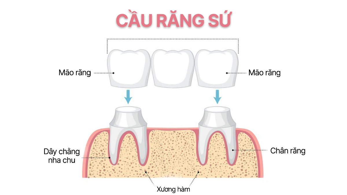 Hình-ảnh-minh-họa-cấu-tạo-cầu-răng-sứ