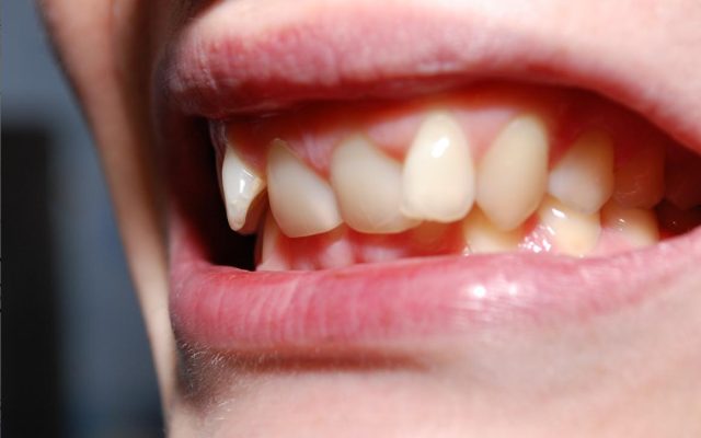 Làm gì khi răng bị lệch lạc