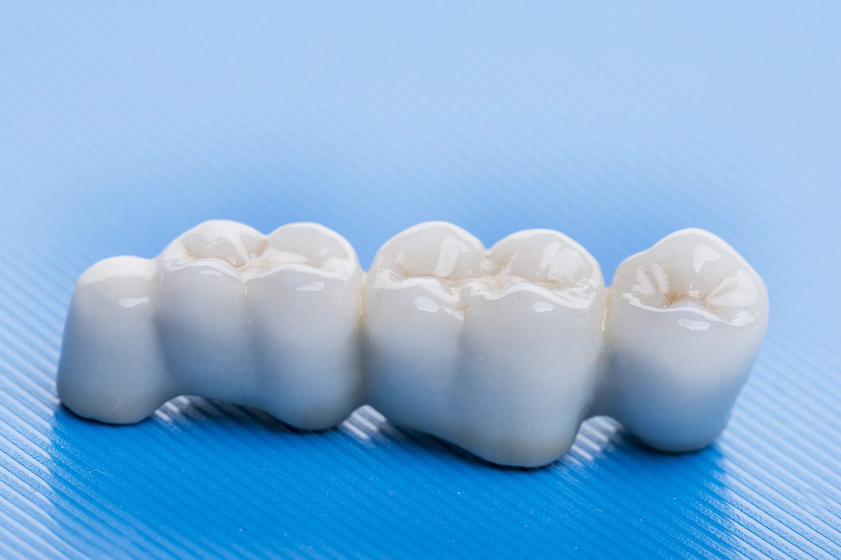 Răng sứ kim loại