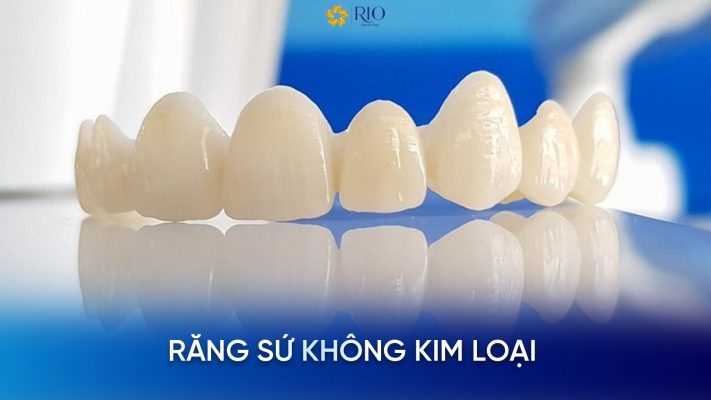 Các loại răng sứ không kim loại