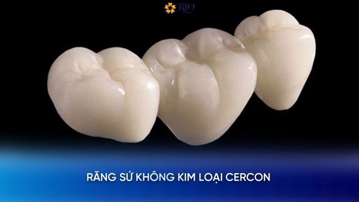 răng sứ không kim loại là gì?