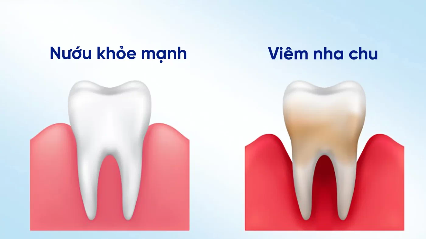 dau-hieu-viem-nha-chu_nha-khoa-rio