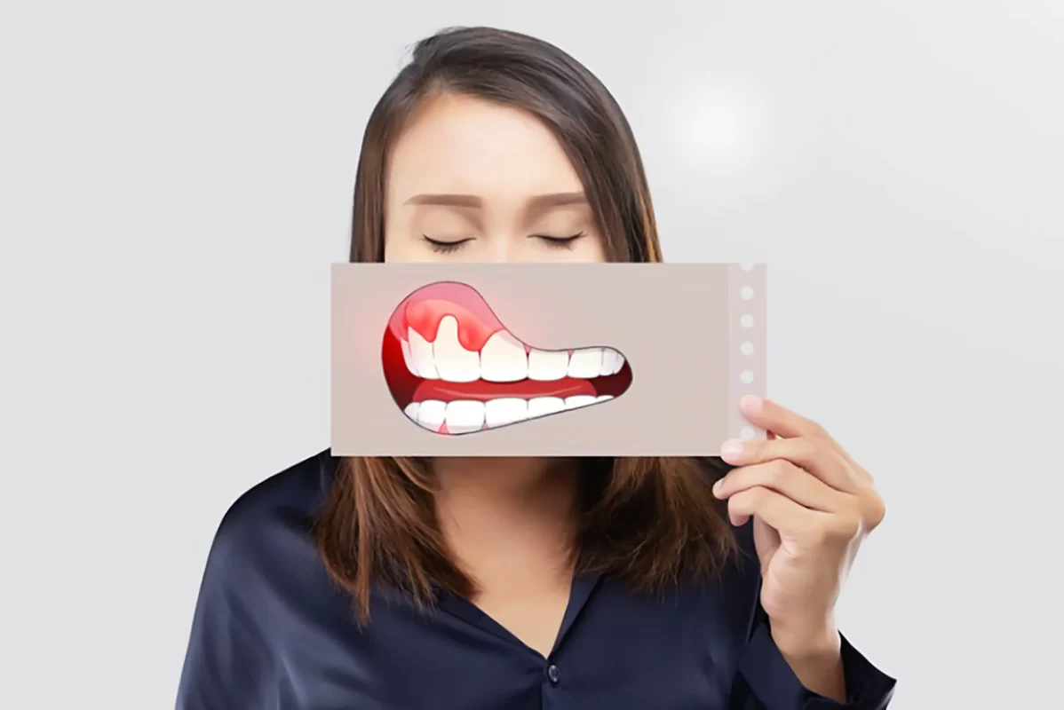 Viêm nướu răng báo hiệu bệnh tim mạch