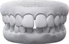 Hình 3D răng thưa