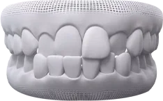 Hình 3D răng khấp khểnh