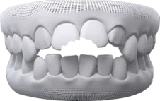 Hình 3D răng sứt mẻ