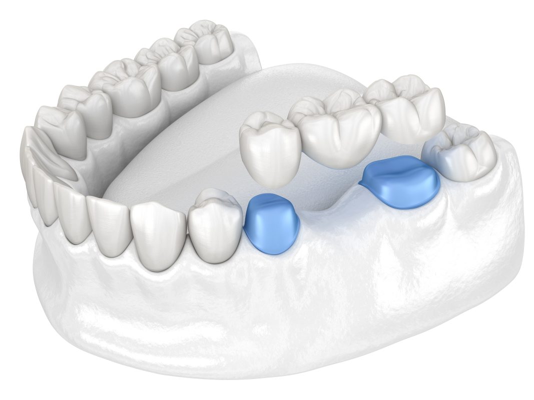 Hình minh họa về cầu răng sứ