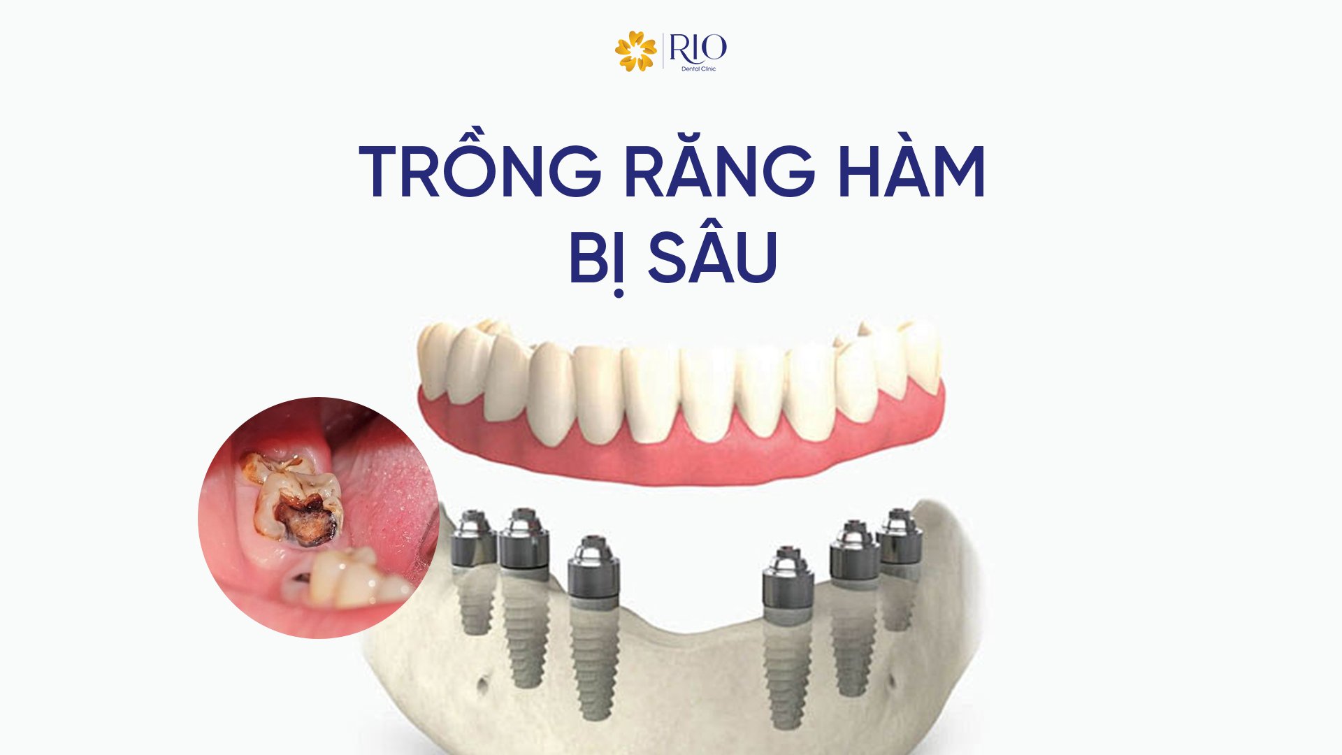 Chi phí trồng răng hàm bị sâu
