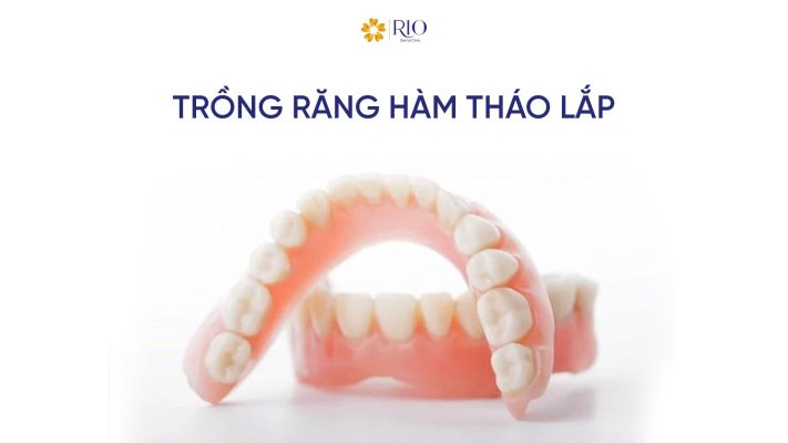trồng răng hàm tháo lắp