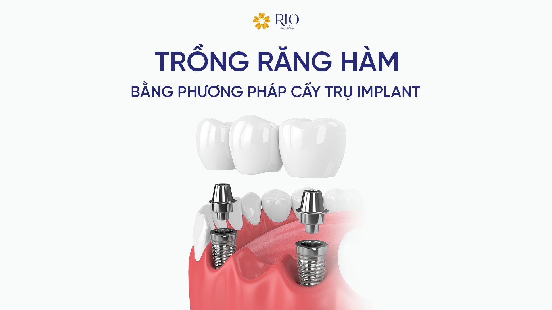 Kỹ thuật trồng răng hàm bằng trụ Implant