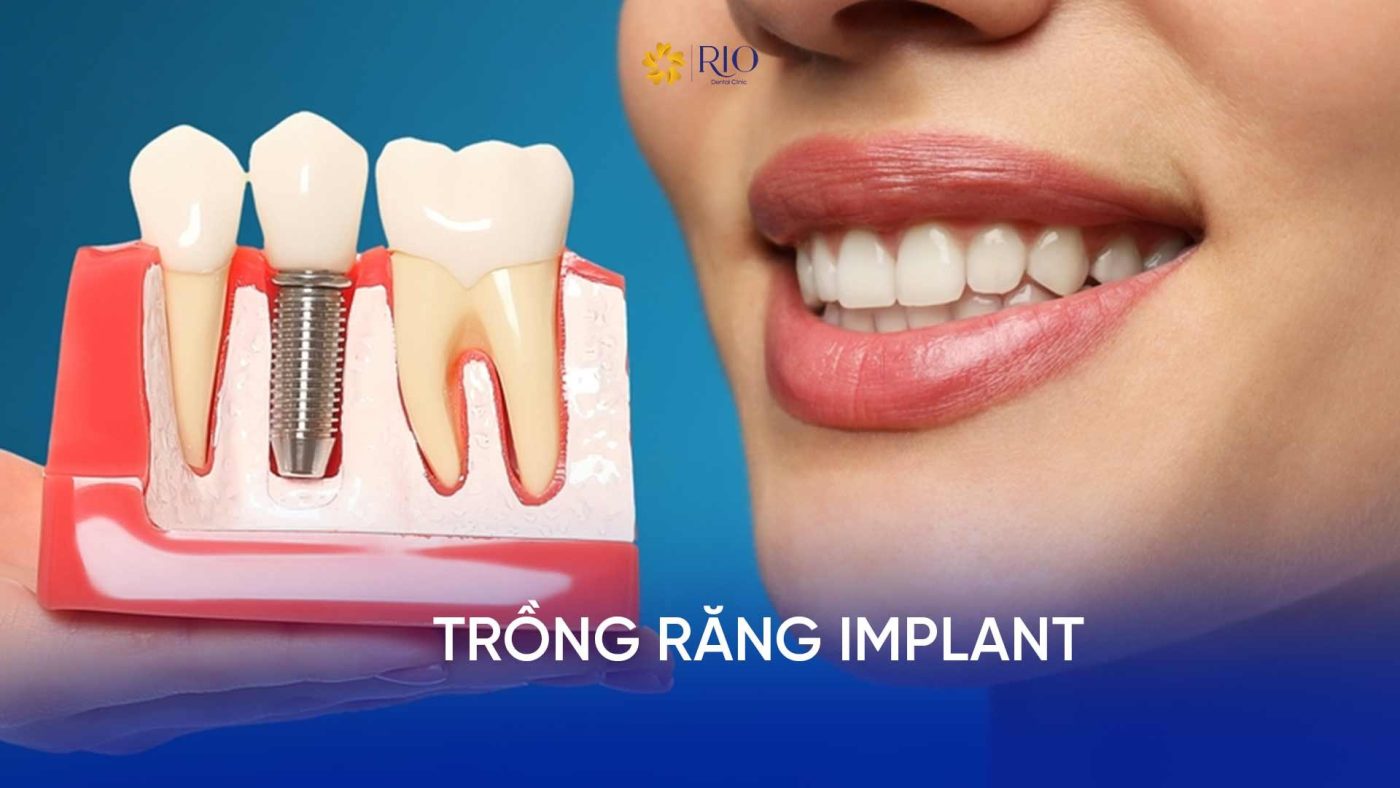 trồng răng implant