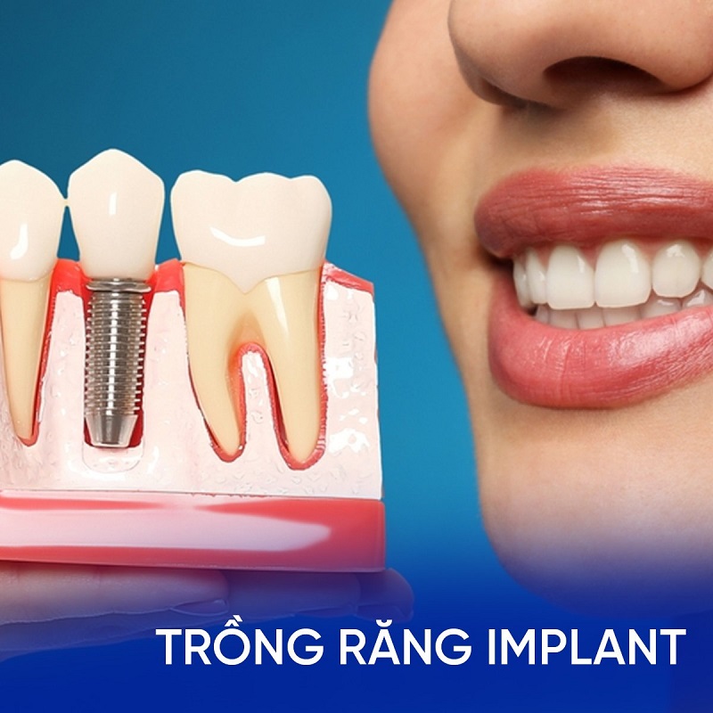 Trồng răng Implant là gì?