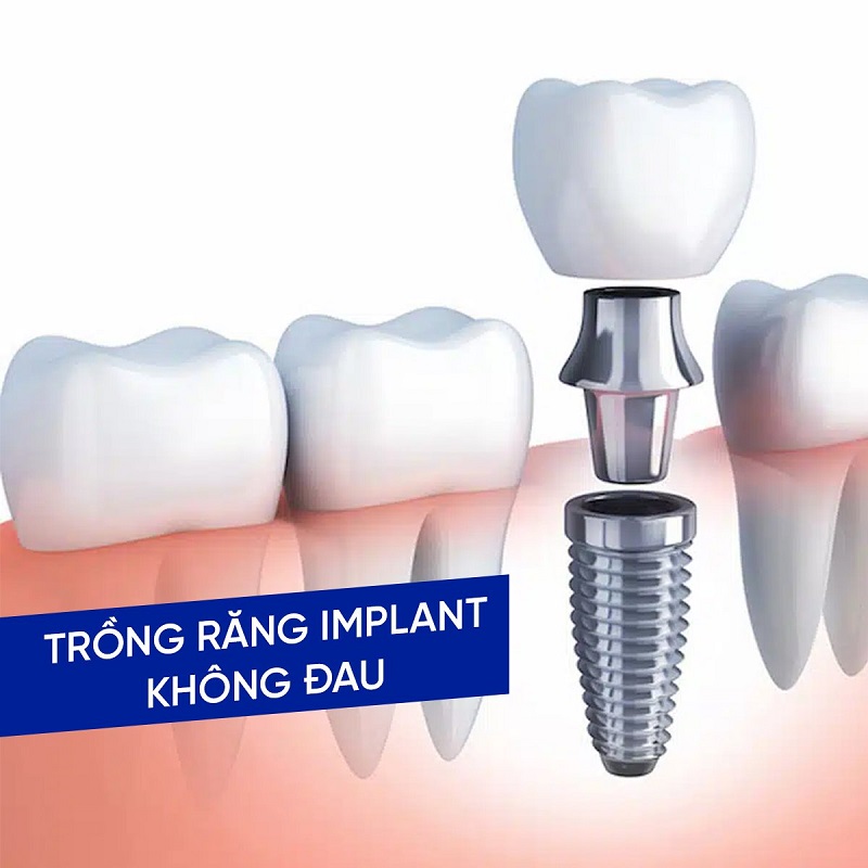 Trồng răng Implant không đau