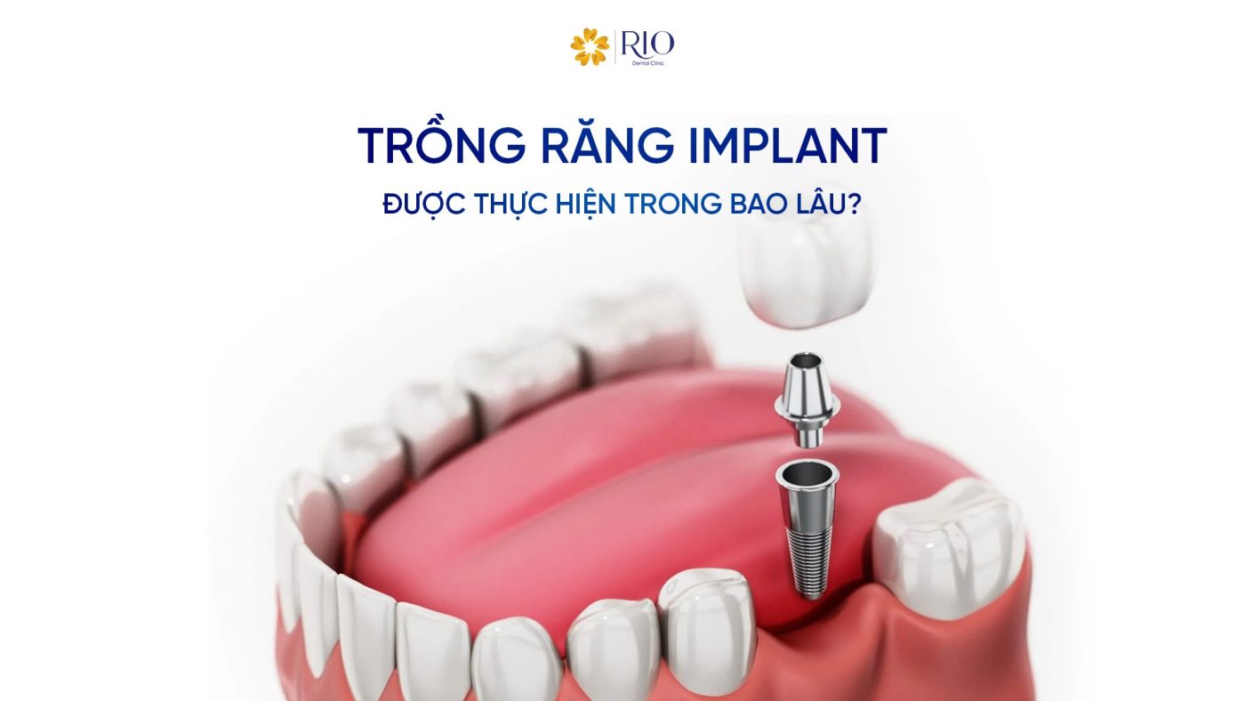 Trồng răng Implant được thực hiện trong bao lâu