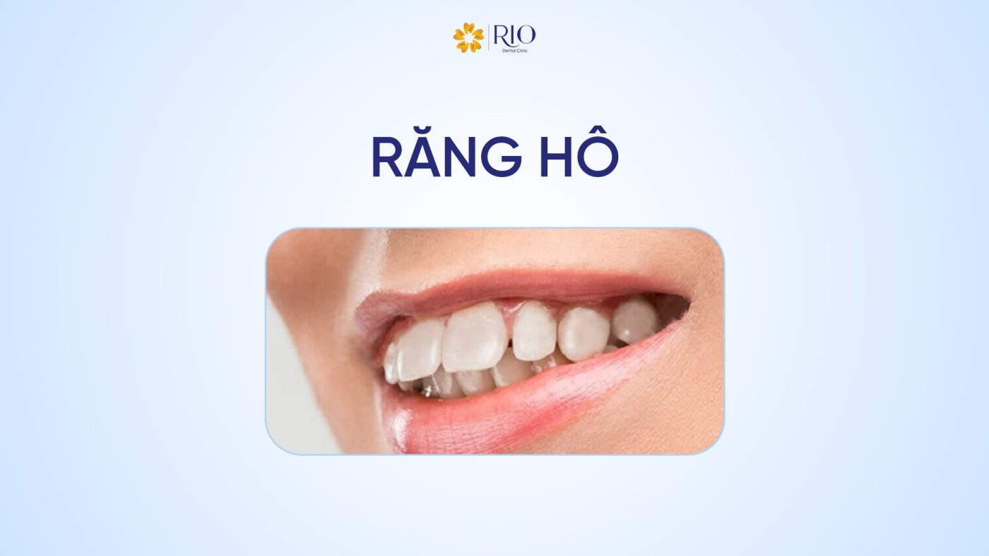 Niềng răng hô có đau không?