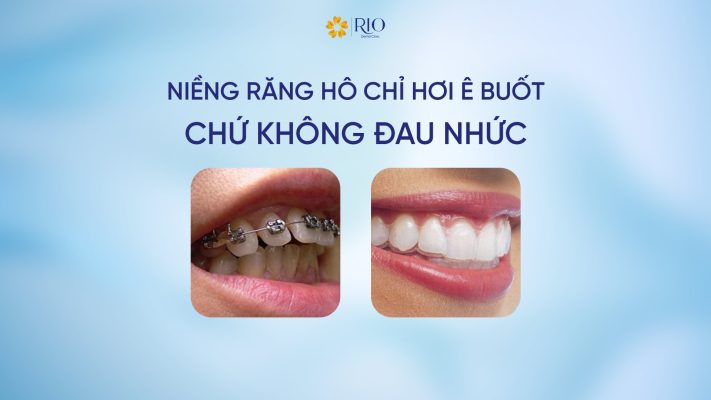 Niềng răng hô chỉ hơi ê buốt chứ không đau nhức nặng nề
