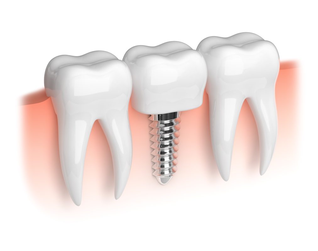 Những ưu điểm của phương pháp trồng răng Implant