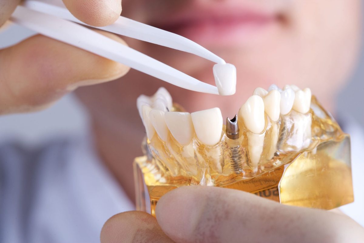 Địa chỉ cấy ghép Implant uy tín