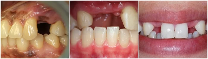 Các trường hợp thích hợp làm cầu răng sứ