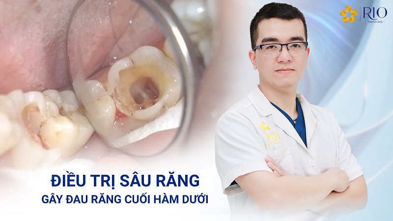 Điều trị Đau răng cuối hàm dưới