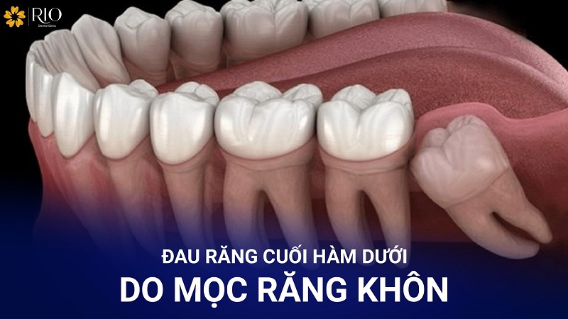 Đau răng cuối hàm dưới do mọc răng khôn