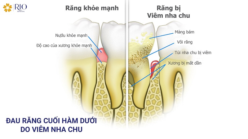 Đau răng cuối hàm dưới do viêm nha chu