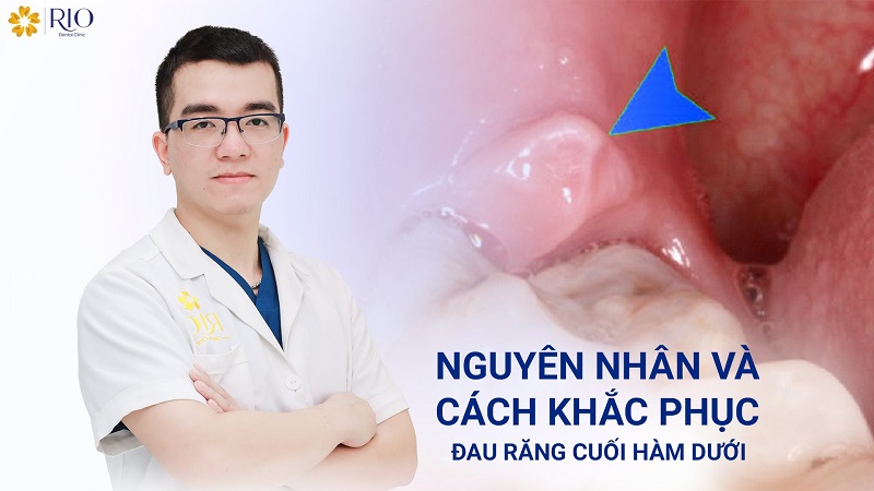 Đau răng cuối hàm dưới