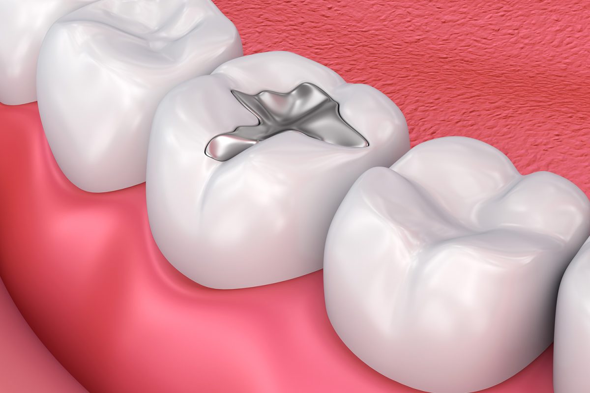 Trám răng bằng Amalgam