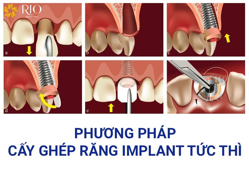 Trồng răng Implant tức thì