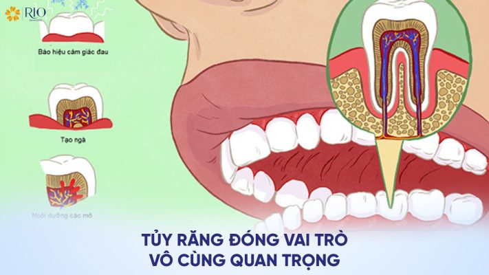 Làm răng sứ có phải lấy tủy không?