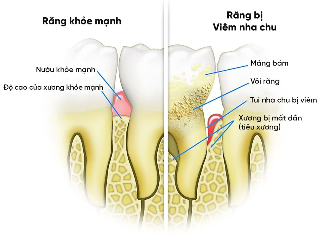 Nguyên nhân viêm nha chu mãn tính