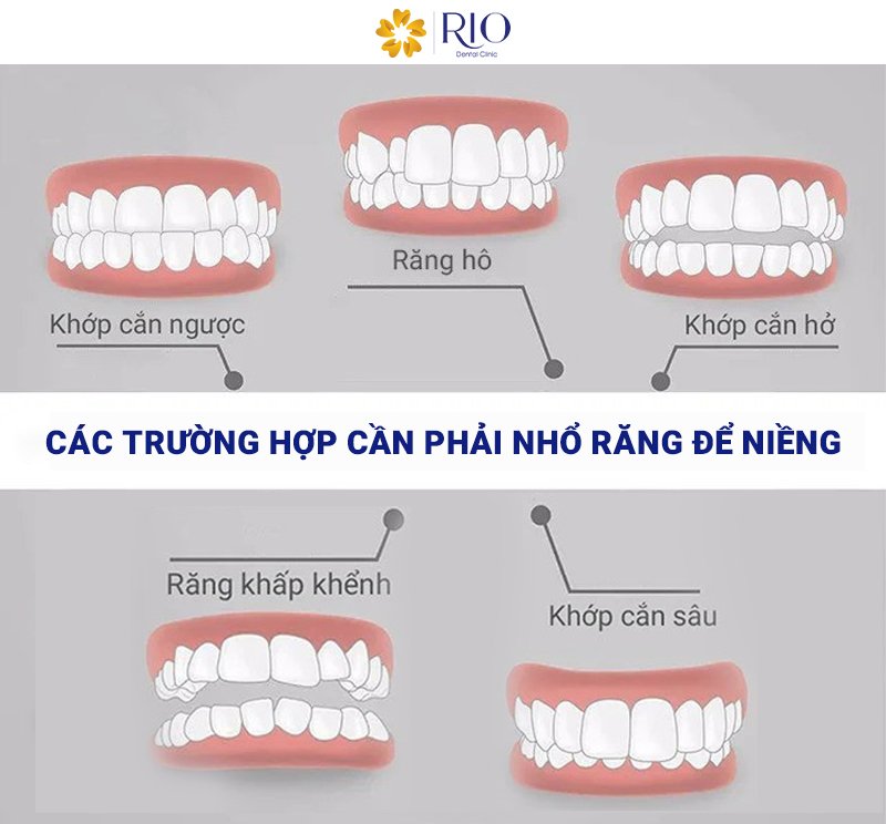 Niềng răng có phải nhổ răng không