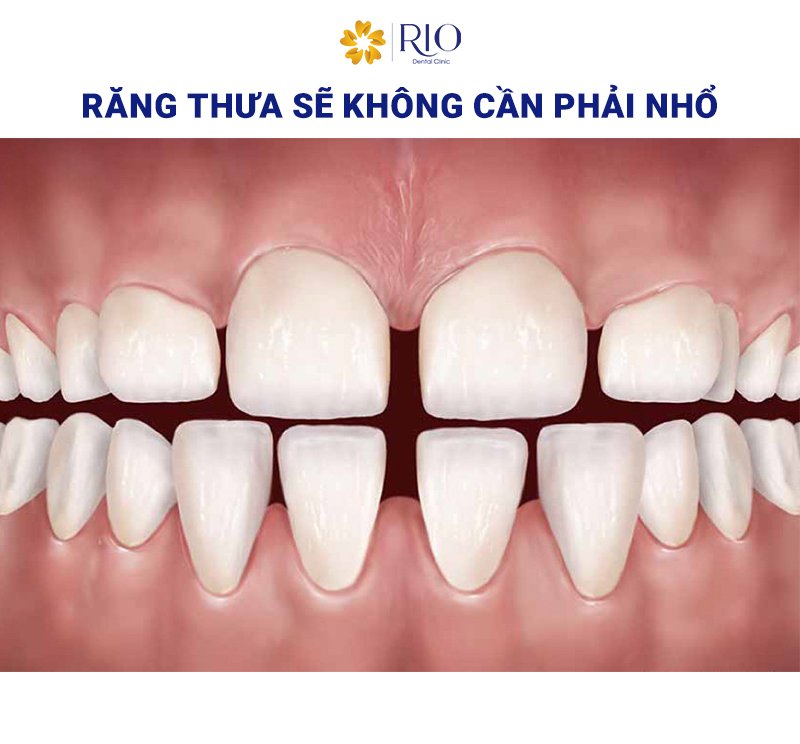 Niềng răng có phải nhổ răng không 2
