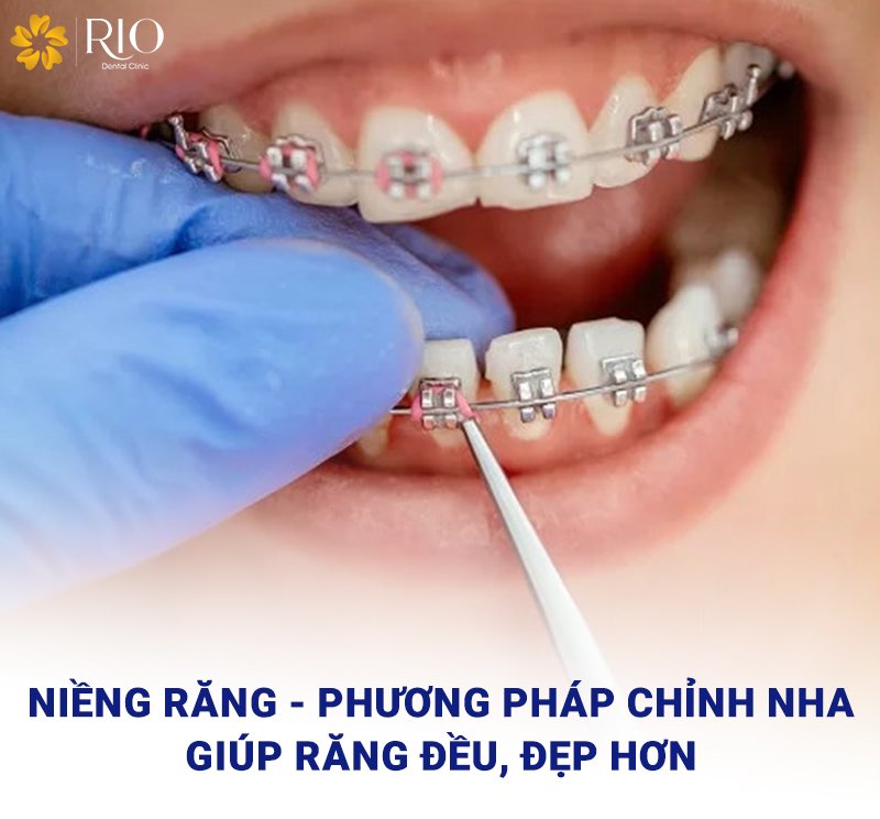Niềng răng có phải nhổ răng không1