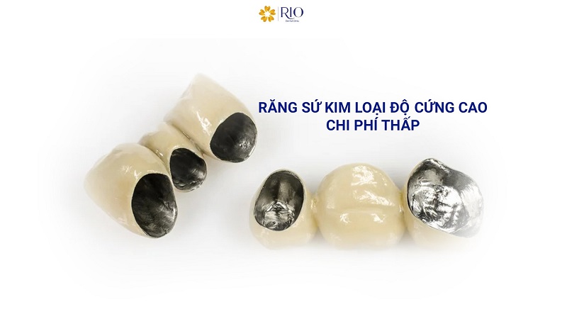 Răng sứ kim loại và răng sứ toàn sứ-1