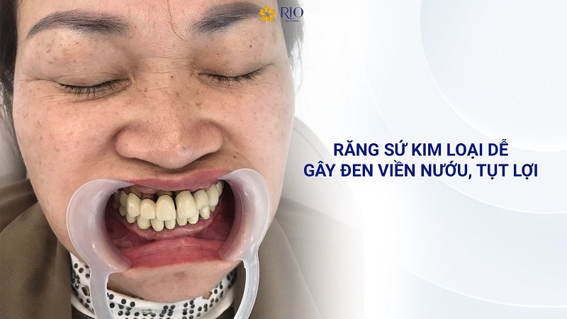 Răng sứ kim loại và răng sứ toàn sứ-2