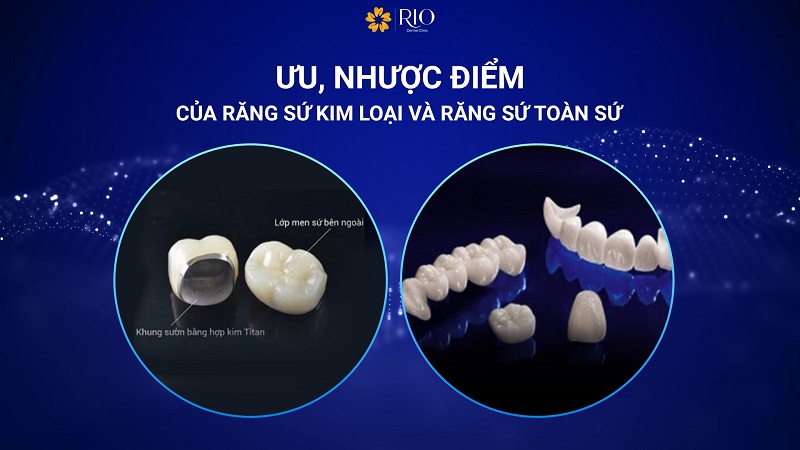 Răng sứ kim loại và răng sứ toàn sứ