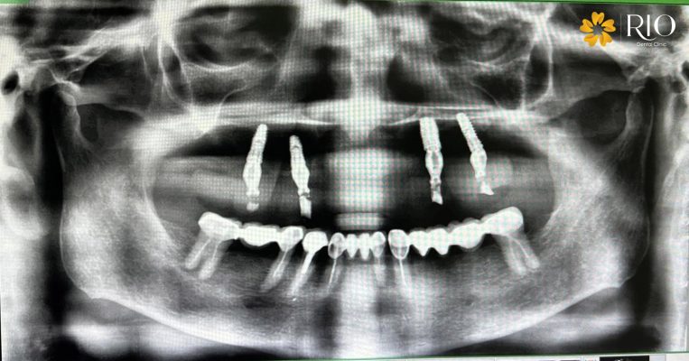 Cụ Trầm bị mất gần hết hàm răng trên phải tiến hành nhổ bỏ và trồng răng Implant
