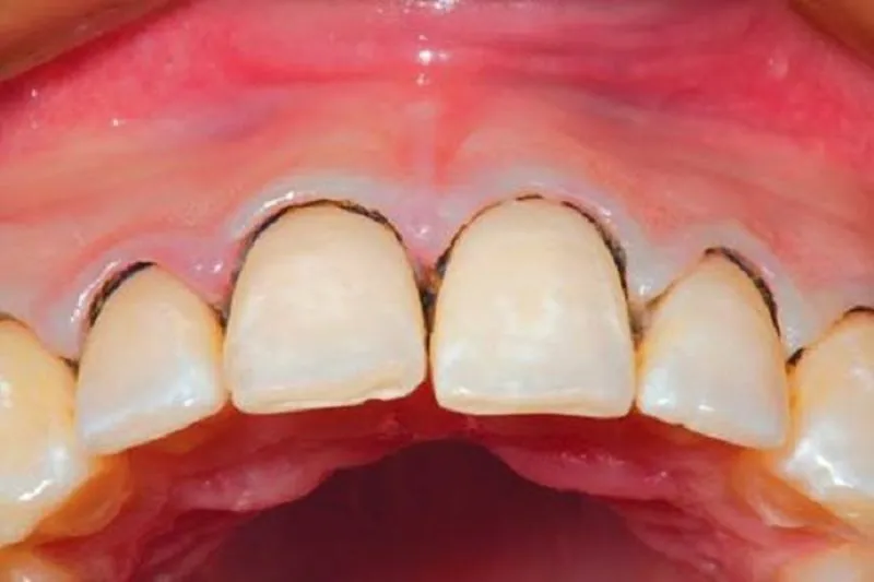 Hình ảnh viêm nha chu