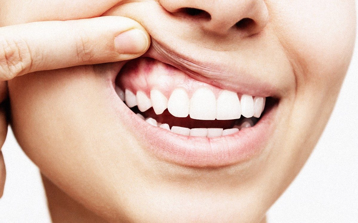 Khi nào nên bọc răng sứ