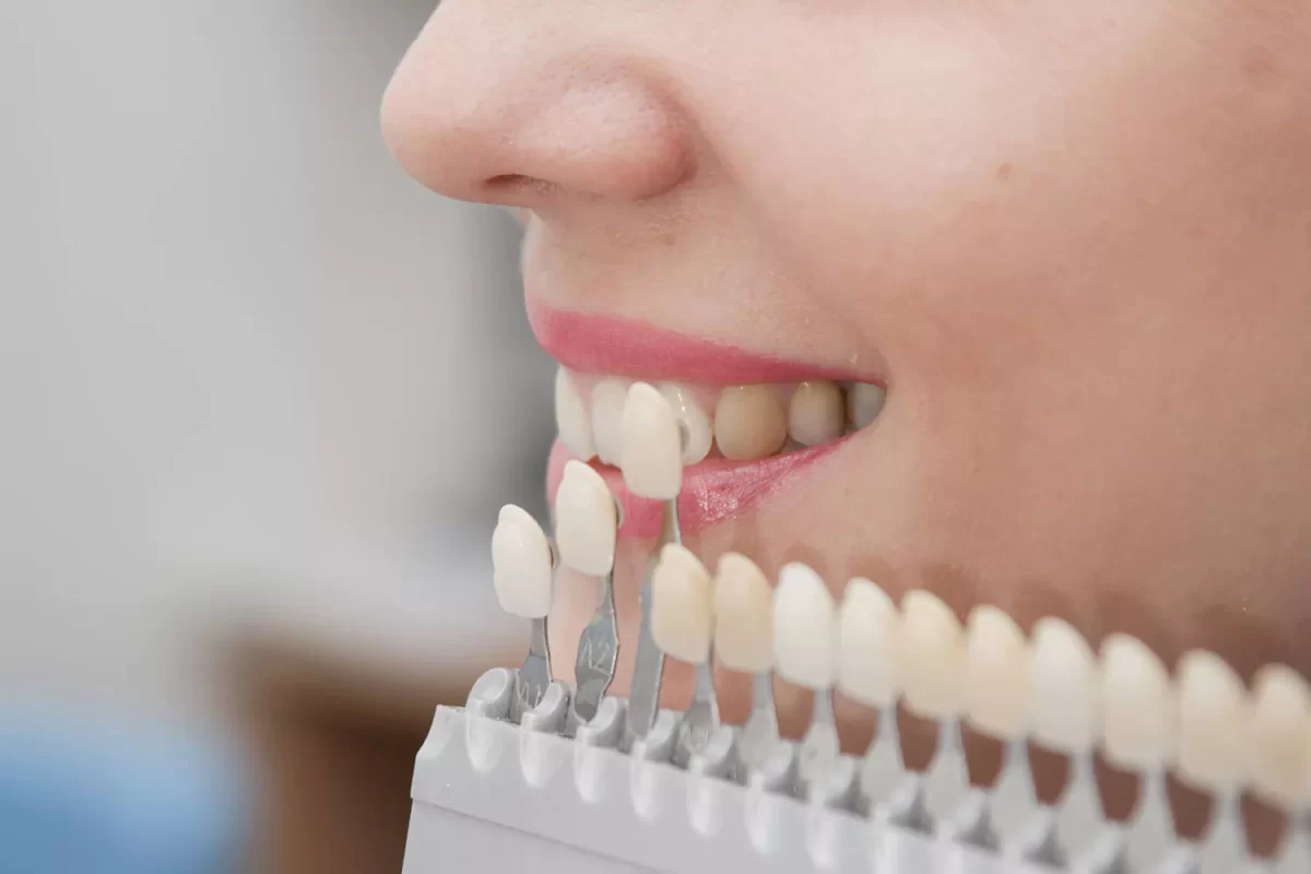 Răng sứ Zirconia có màu trắng tự nhiên như răng thật