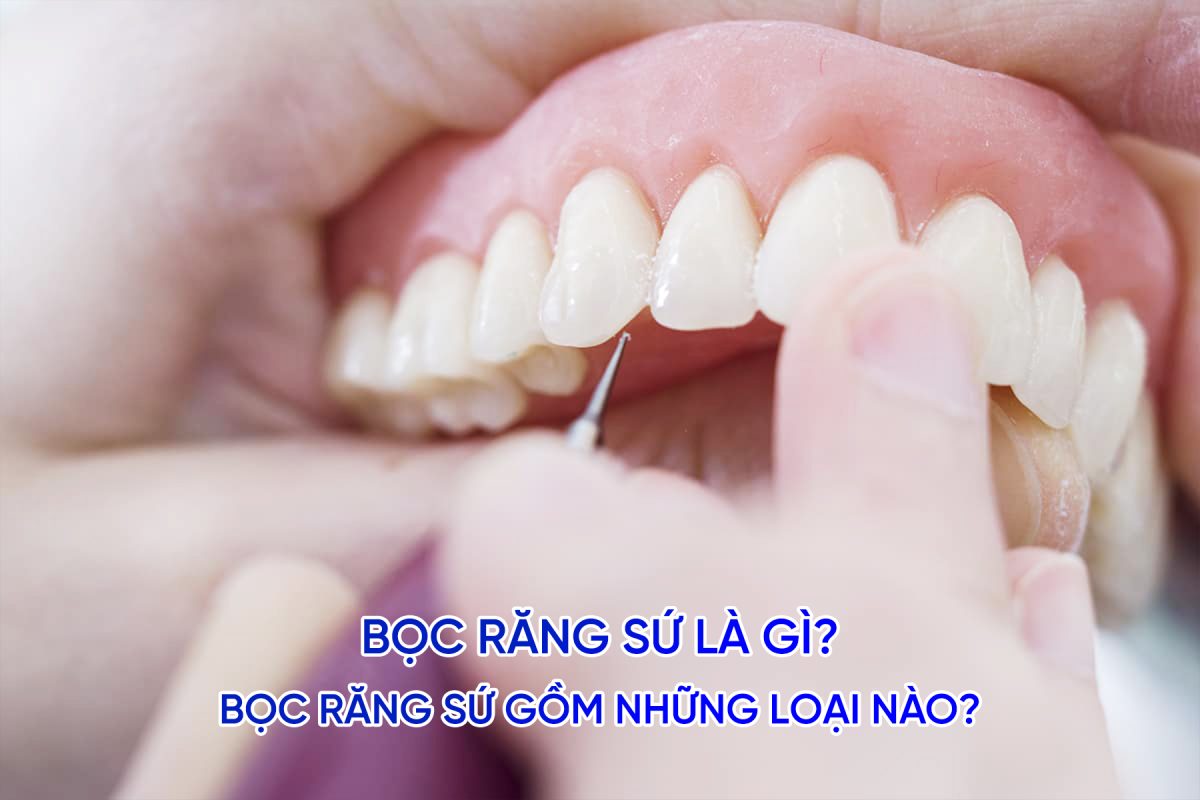 boc-rang-su-la-gi