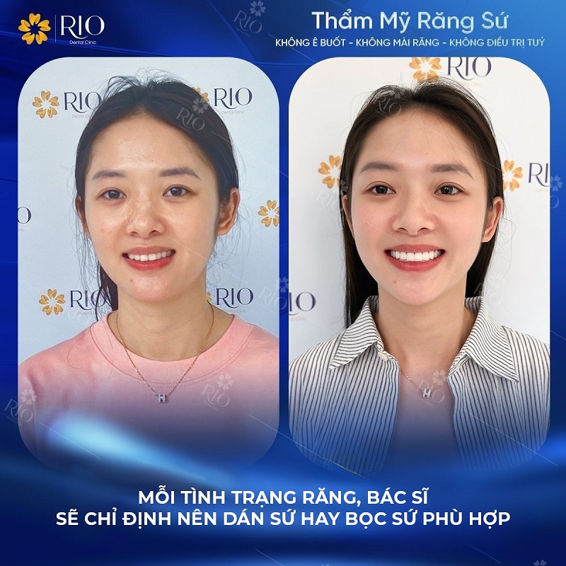 Độ bền của miếng dán sứ Veneer và bọc răng sứ tương đương nhau. boc-rang-su-va-dan-rang-su-khac-nhau-nhu-the-nao bạn ơi