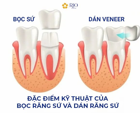 chà nhám để dán sứ, bọc răng sứ. boc-rang-su-va-dan-rang-su-khac-nhau-nhu-the-nao